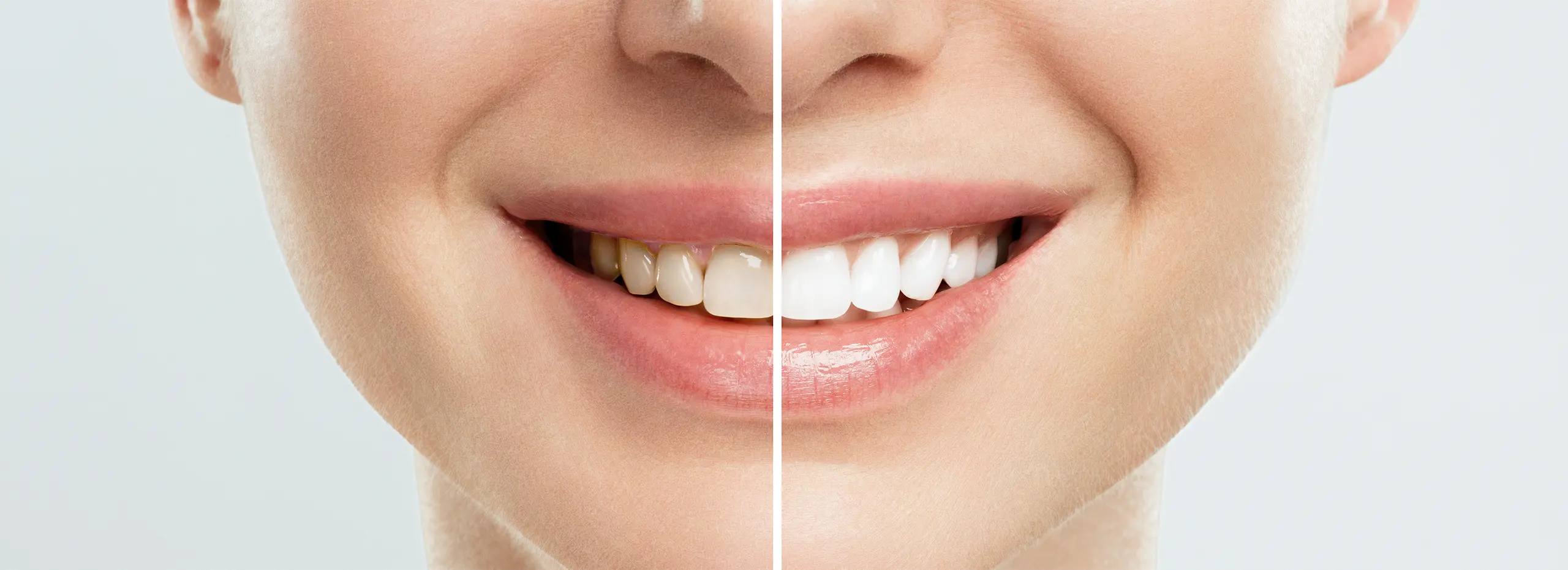 Vergleich der Zähne vor und nach dem Bleaching